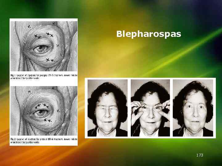 Blepharospas 173 