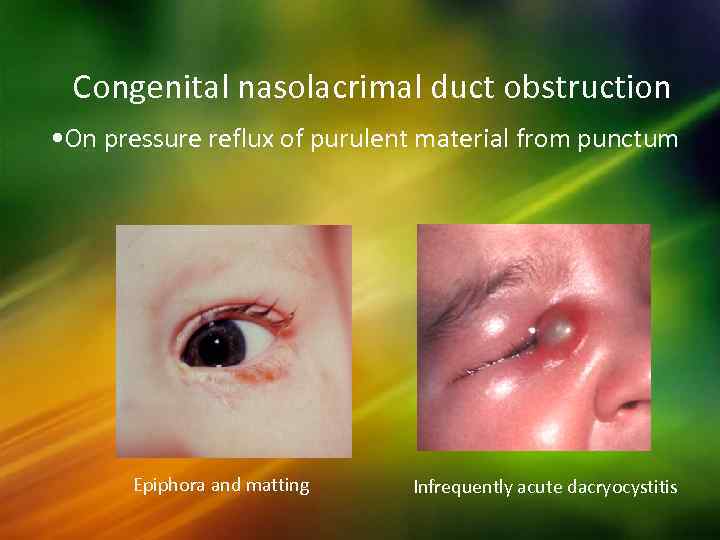 Congenital nasolacrimal duct obstruction • On pressure reflux of purulent material from punctum Epiphora