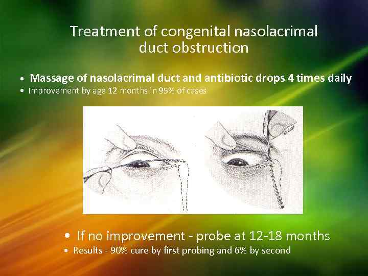 Treatment of congenital nasolacrimal duct obstruction • Massage of nasolacrimal duct and antibiotic drops