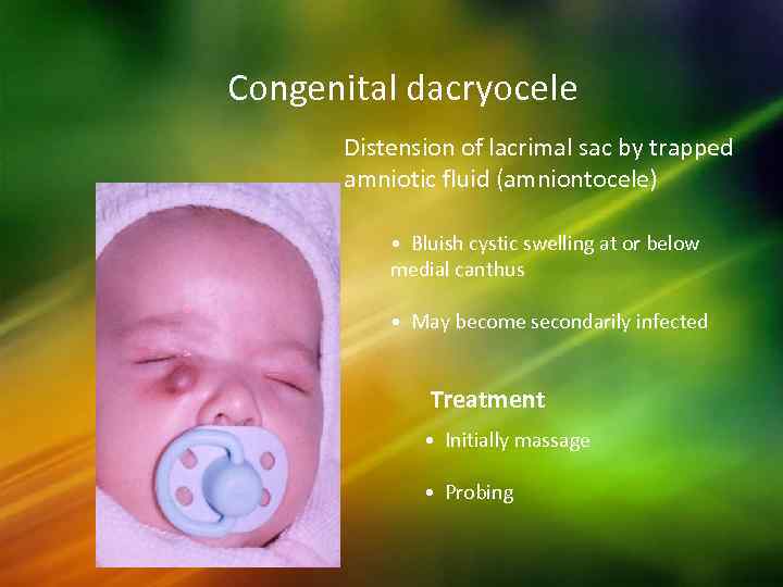 Congenital dacryocele Distension of lacrimal sac by trapped amniotic fluid (amniontocele) • Bluish cystic