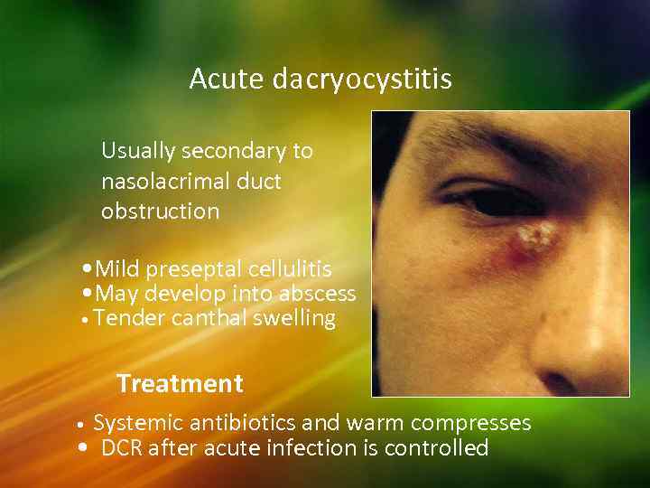 Acute dacryocystitis Usually secondary to nasolacrimal duct obstruction • Mild preseptal cellulitis • May