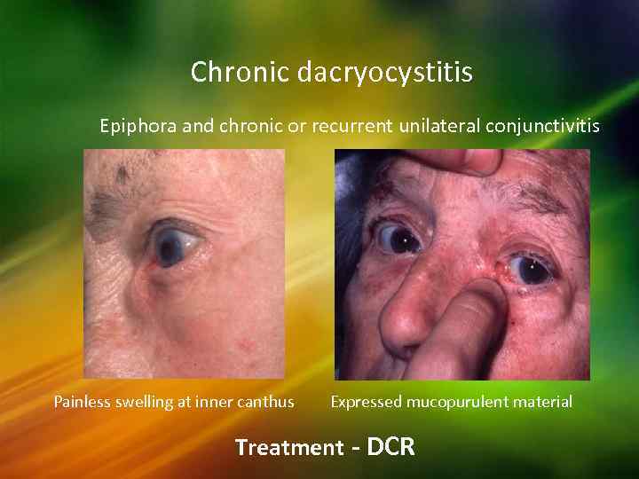 Chronic dacryocystitis Epiphora and chronic or recurrent unilateral conjunctivitis Painless swelling at inner canthus