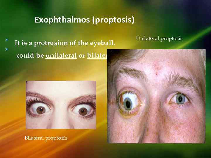 Exophthalmos (proptosis) It is a protrusion of the eyeball. could be unilateral or bilateral.