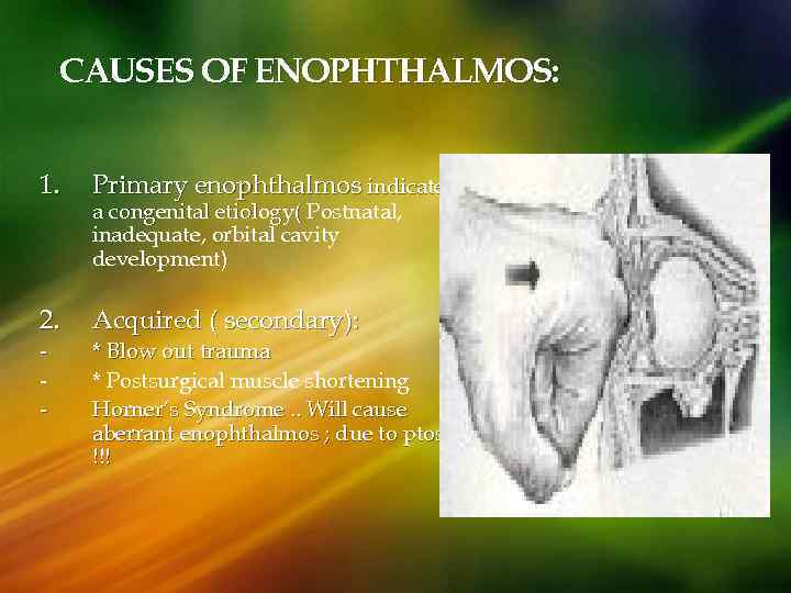 CAUSES OF ENOPHTHALMOS: 1. Primary enophthalmos indicates 2. Acquired ( secondary): - a congenital
