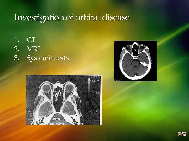 Investigation of orbital disease 1. 2. 3. CT MRI Systemic tests 