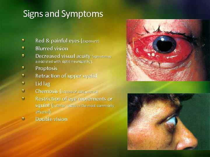Signs and Symptoms Red & painful eyes (exposure) Blurred vision Decreased visual acuity (sometimes