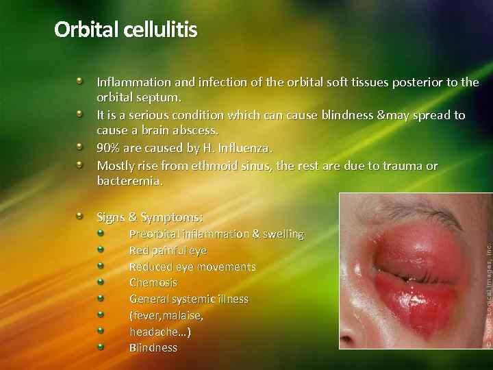 Orbital cellulitis Inflammation and infection of the orbital soft tissues posterior to the orbital