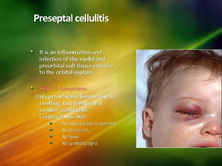 Preseptal cellulitis It is an inflammation and infection of the eyelid and preorbital soft