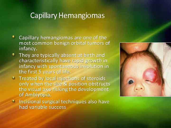 Capillary Hemangiomas Capillary hemangiomas are one of the most common benign orbital tumors of