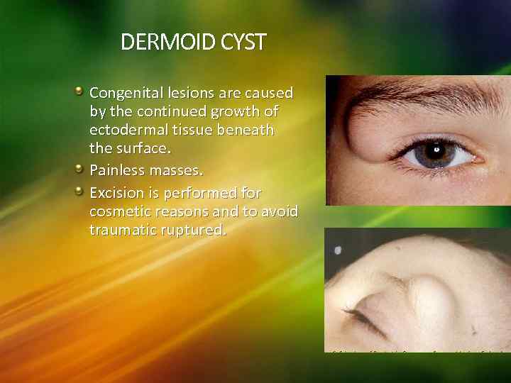 DERMOID CYST Congenital lesions are caused by the continued growth of ectodermal tissue beneath