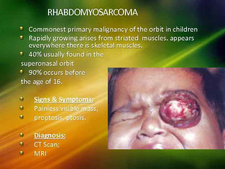 RHABDOMYOSARCOMA Commonest primary malignancy of the orbit in children Rapidly growing arises from striated