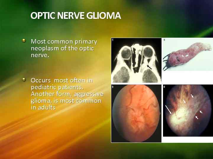 OPTIC NERVE GLIOMA Most common primary neoplasm of the optic nerve. Occurs most often