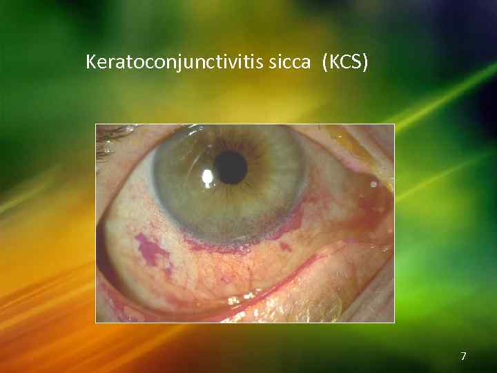 Keratoconjunctivitis sicca (KCS) 7 