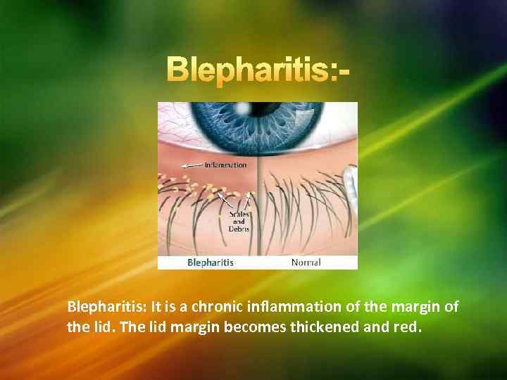 Blepharitis: It is a chronic inflammation of the margin of the lid. The lid
