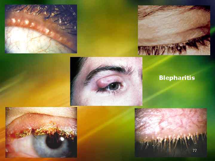 Blepharitis 77 