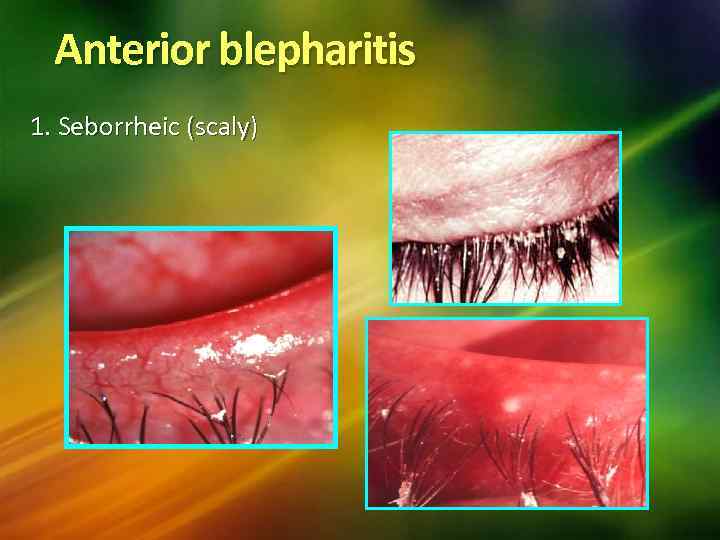 Anterior blepharitis 1. Seborrheic (scaly) 