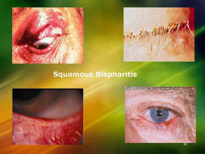 Squamous Blepharitis 81 