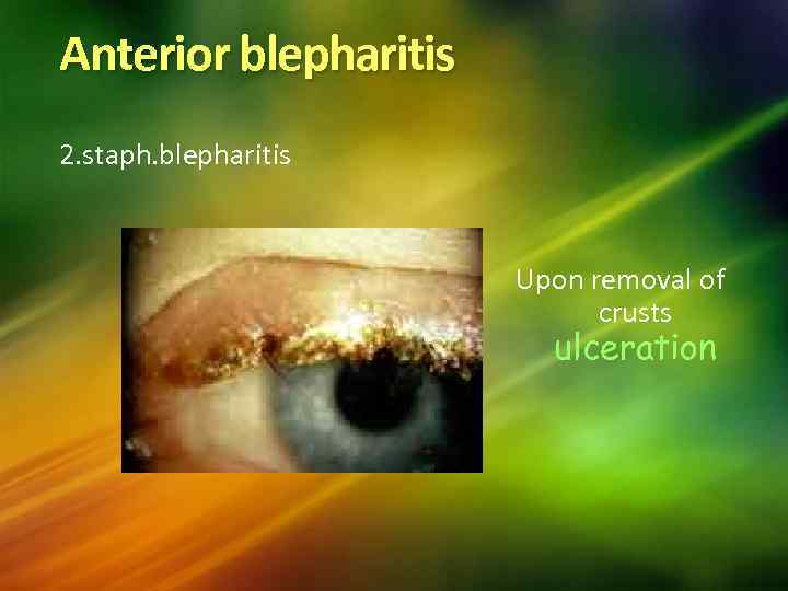 Anterior blepharitis 2. staph. blepharitis Upon removal of crusts ulceration 