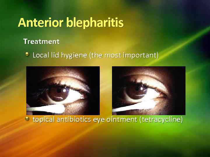 Anterior blepharitis Treatment Local lid hygiene (the most important) topical antibiotics eye ointment (tetracycline)