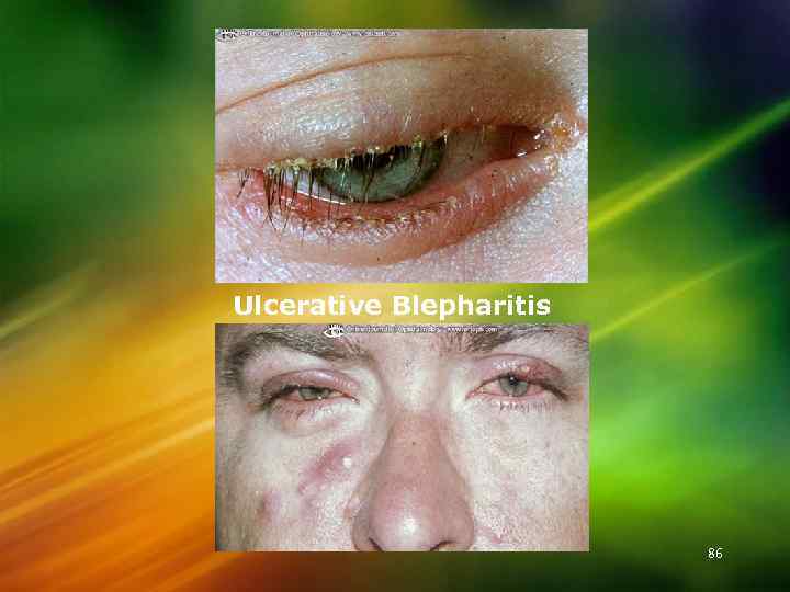 Ulcerative Blepharitis 86 