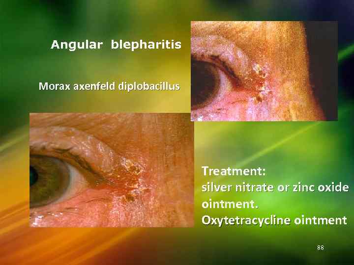 Angular blepharitis Morax axenfeld diplobacillus Treatment: silver nitrate or zinc oxide ointment. Oxytetracycline ointment