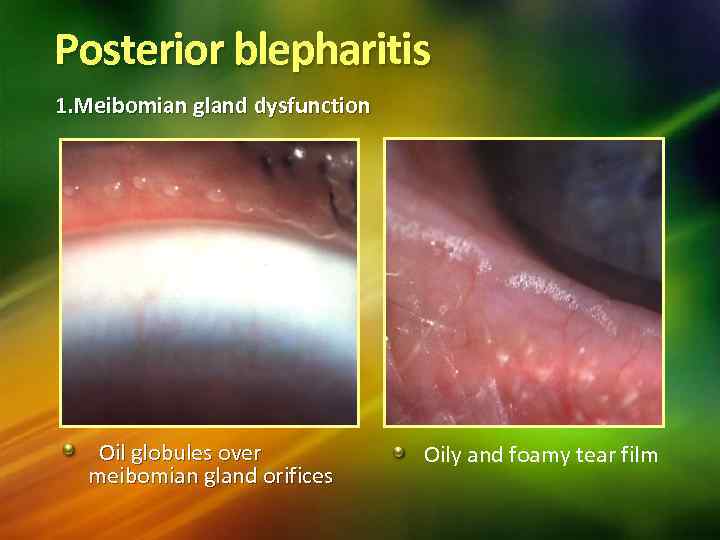 Posterior blepharitis 1. Meibomian gland dysfunction Oil globules over meibomian gland orifices Oily and