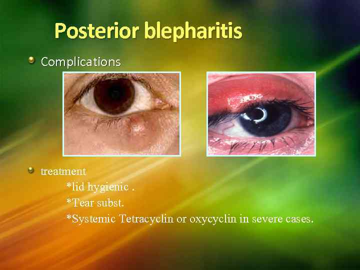 Posterior blepharitis Complications treatment *lid hygienic. *Tear subst. *Systemic Tetracyclin or oxycyclin in severe