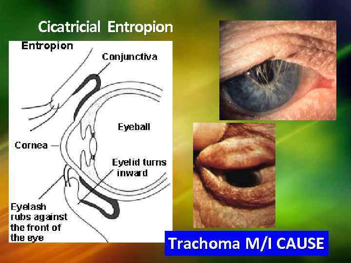 Cicatricial Entropion Trachoma M/I CAUSE 