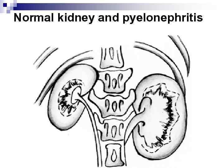 Normal kidney and pyelonephritis 