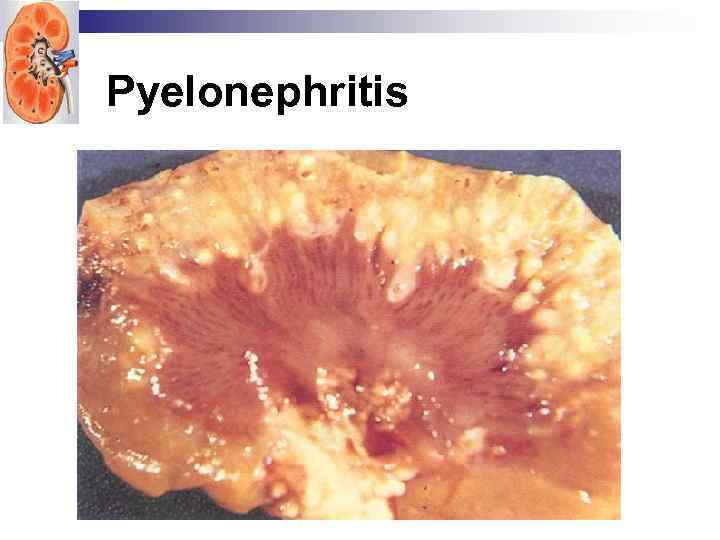Pyelonephritis 