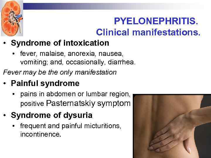 PYELONEPHRITIS. Clinical manifestations. • Syndrome of intoxication • fever, malaise, anorexia, nausea, vomiting; and,