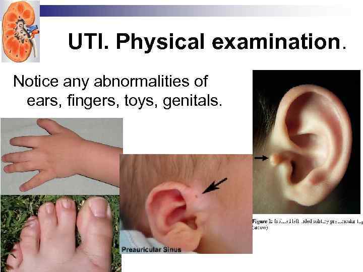 UTI. Physical examination. Notice any abnormalities of ears, fingers, toys, genitals. 