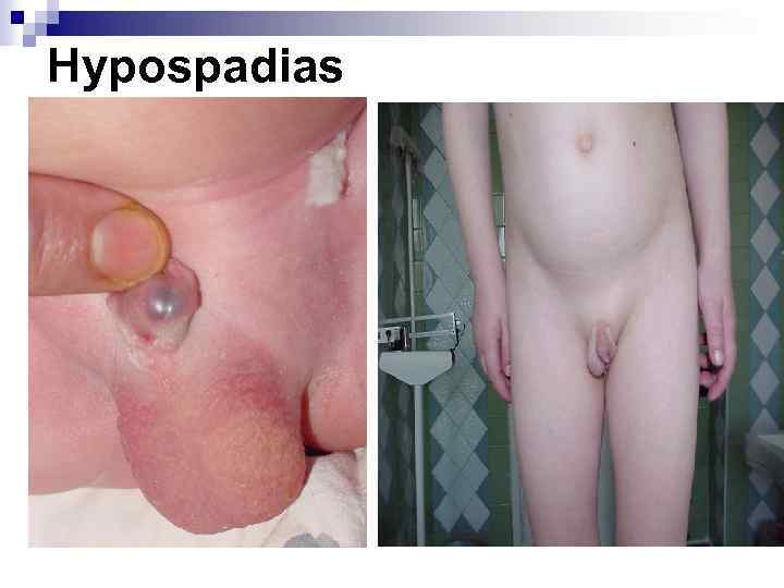 Hypospadias 