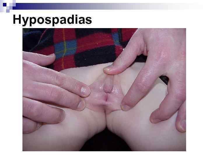 Hypospadias 