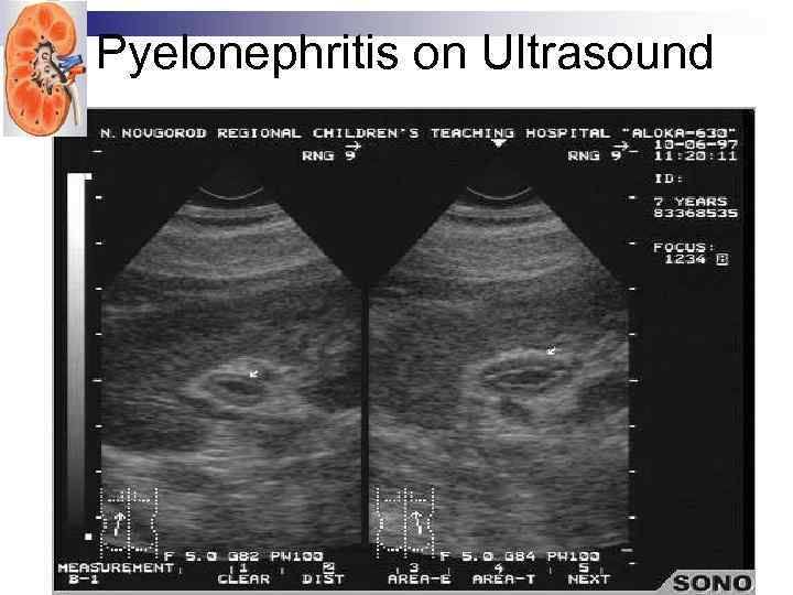 Pyelonephritis on Ultrasound 