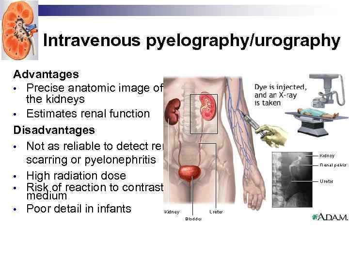 Intravenous pyelography/urography Advantages • Precise anatomic image of the kidneys • Estimates renal function