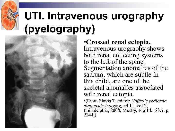 UTI. Intravenous urography (pyelography) • Crossed renal ectopia. Intravenous urography shows both renal collecting