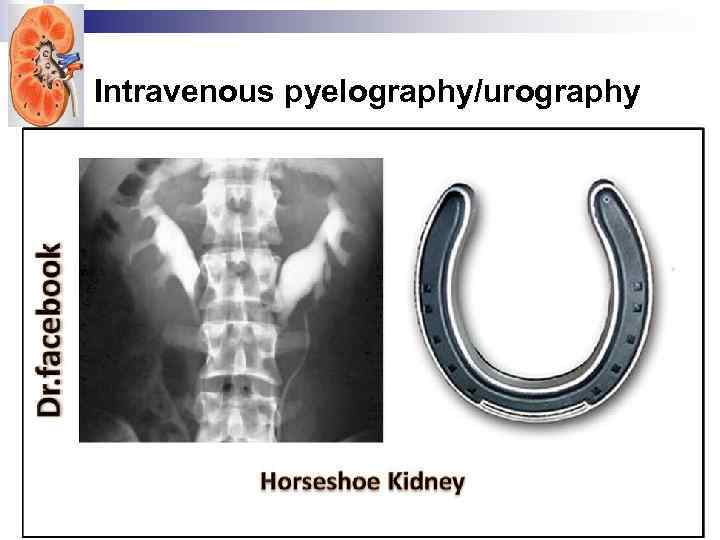 Intravenous pyelography/urography 