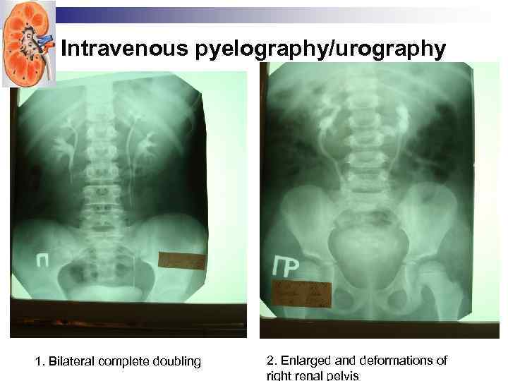 Intravenous pyelography/urography 1. Bilateral complete doubling 2. Enlarged and deformations of right renal pelvis