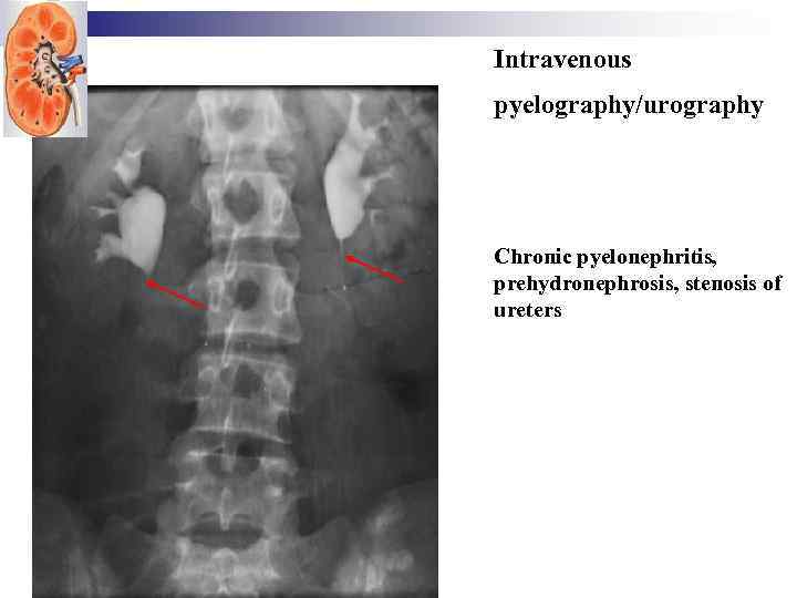 Intravenous pyelography/urography Chronic pyelonephritis, prehydronephrosis, stenosis of ureters 