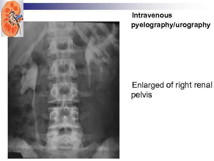 Intravenous pyelography/urography Enlarged of right renal pelvis 