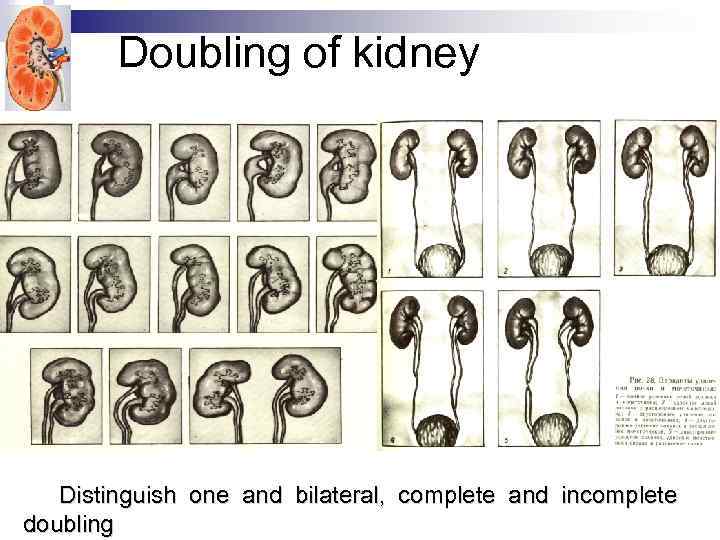 Doubling of kidney Distinguish one and bilateral, complete and incomplete doubling 