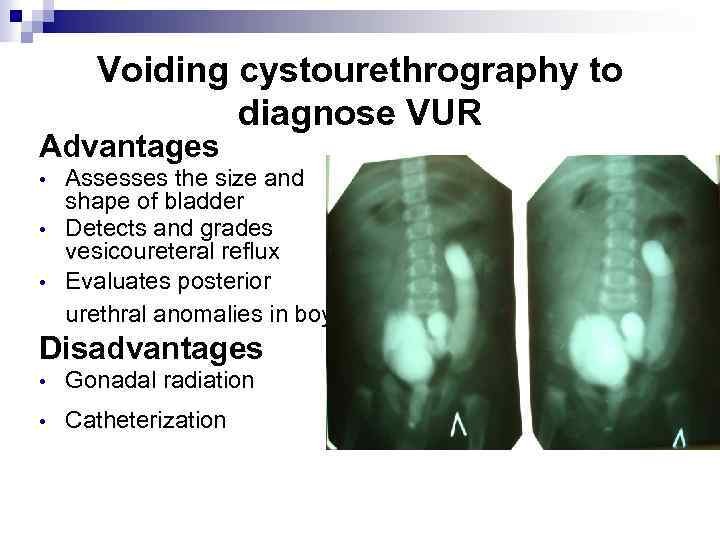 Voiding cystourethrography to diagnose VUR Advantages • • • Assesses the size and shape