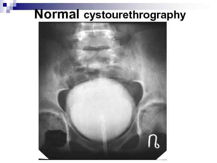 Normal cystourethrography 