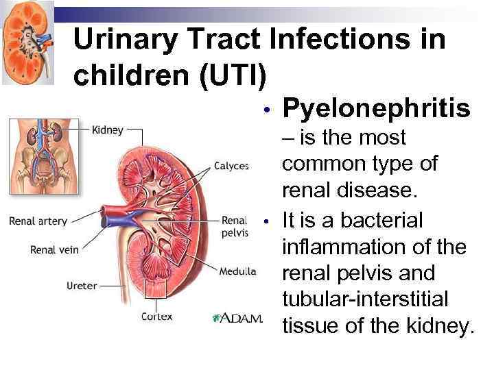 Urinary Tract Infections in children (UTI) • • Pyelonephritis – is the most common