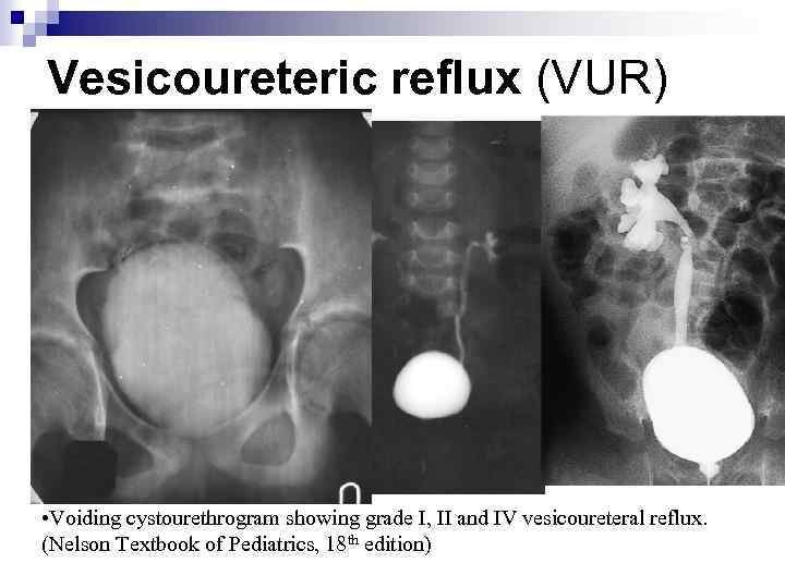Vesicoureteric reflux (VUR) • Voiding cystourethrogram showing grade I, II and IV vesicoureteral reflux.