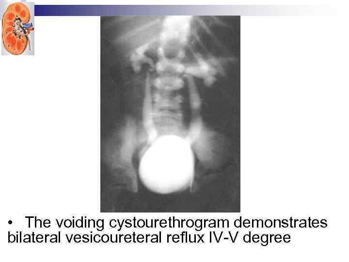  • The voiding cystourethrogram demonstrates bilateral vesicoureteral reflux IV-V degree 