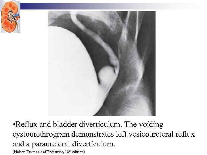  • Reflux and bladder diverticulum. The voiding cystourethrogram demonstrates left vesicoureteral reflux and