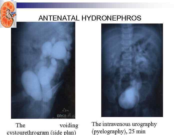 ANTENATAL HYDRONEPHROS The voiding cystourethrogram (side plan) The intravenous urography (pyelography), 25 min 