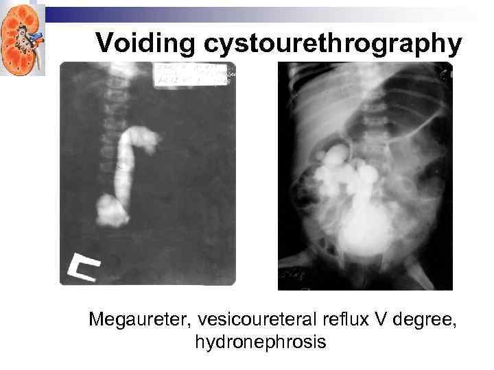 Voiding cystourethrography Megaureter, vesicoureteral reflux V degree, hydronephrosis 